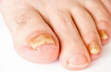 semne ale ciupercii unghiilor de la picioare cum să trateze